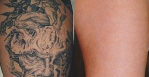 laser_tattoo_removal01-e1520592204153