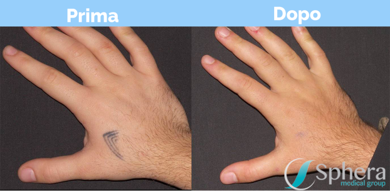 rimozione-tatuaggio-prima-dopo-1-e1520606727316