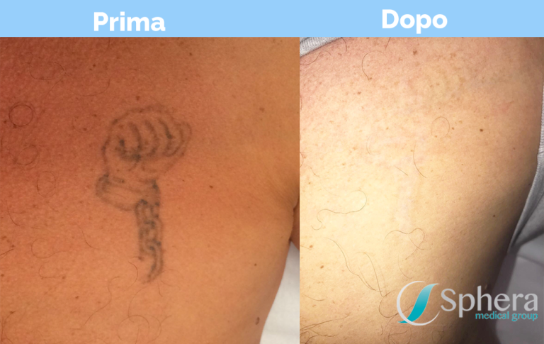 rimozione-tatuaggio-prima-dopo-4-e1520606644738