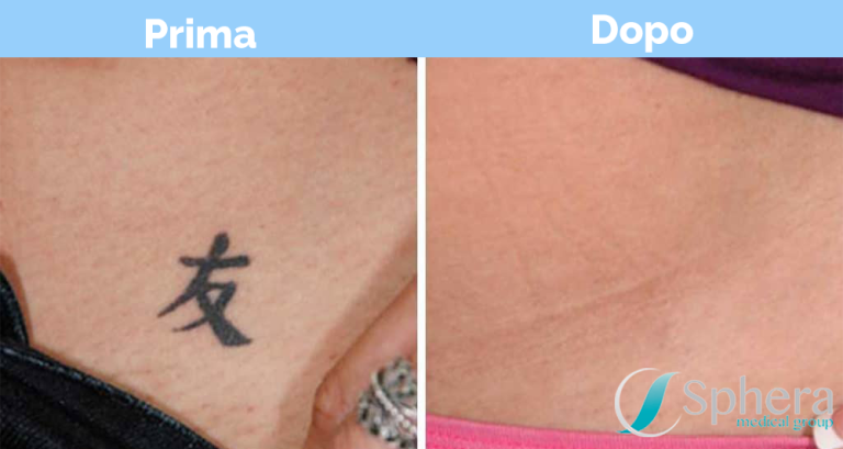rimozione-tatuaggio-prima-dopo-5-e1520606625208